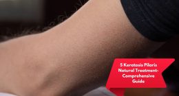 5 Keratosis Pilaris Natural Treatment