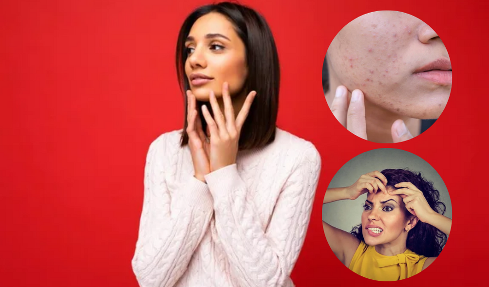 Hormonal Acne in Women