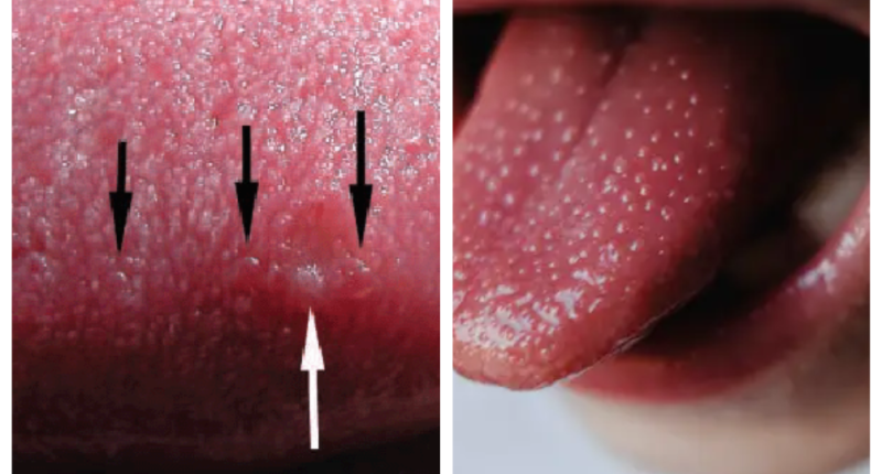 Eruptive Lingual Papillitis Treatment: Symptoms, Causes, Preventative Care