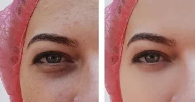 Dark Circles After Rhinoplasty: Causes and Treatment