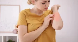 How Climate Change Can Affect This Skin Condition