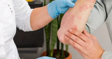 Managing Chronic Inflammation with Psoriasis: Expert Guide