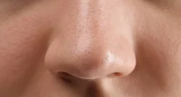 Navigating Post-Rhinoplasty Discontent: A Comprehensive Guide