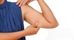 Non Surgical Arm Fat Removal: A Comprehensive Guide