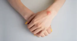 Lipoma Treatment Without Surgery: Exploring Non-Invasive Solutions